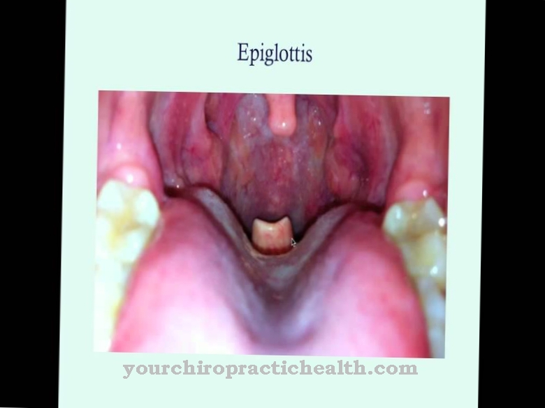 epiglotitas