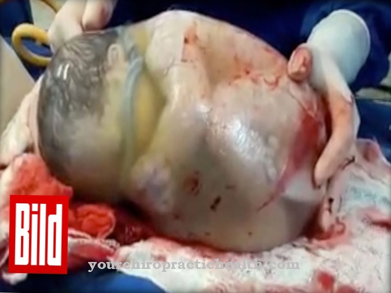 Amniotic sac