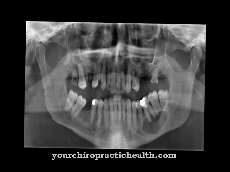 Maxillary sinus