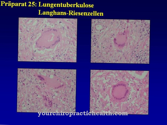 Langhans giant cells