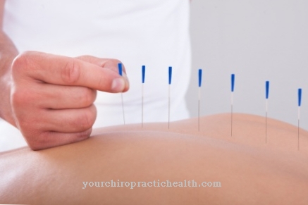 acupuncture