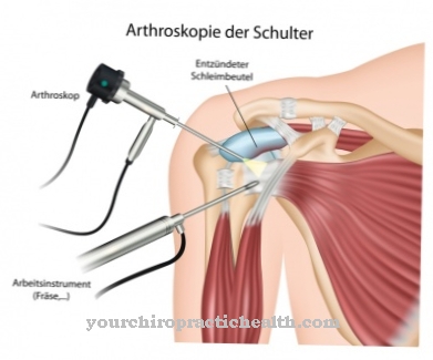 Arthroscopy