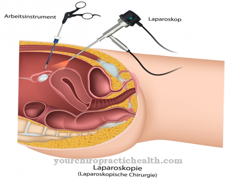 Laparoscopy