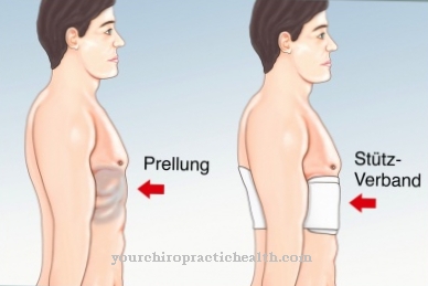 Tratamento para hematomas