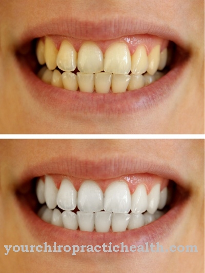 Whitening