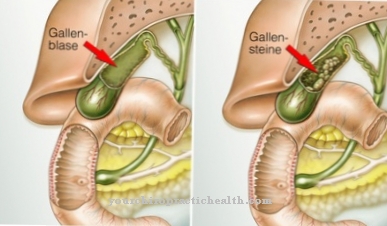 Cholecystectomy