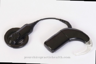 Cochlear implant