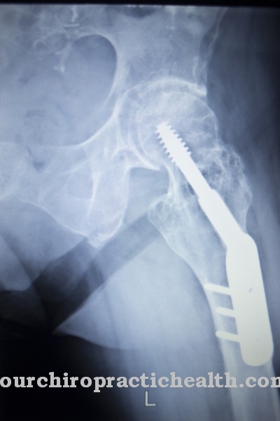 Dynamic hip screw