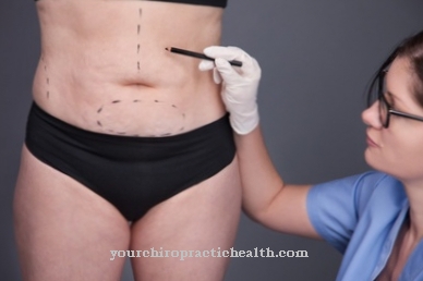 Liposuction