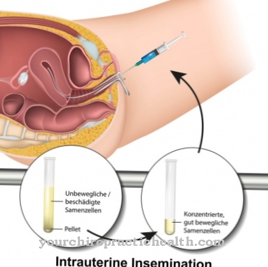 Intrauterin insemination