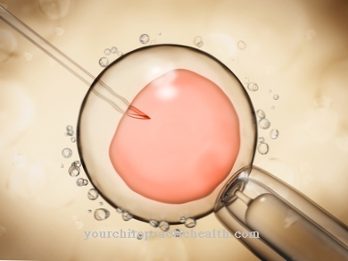 Intracytoplasmic sperm injection