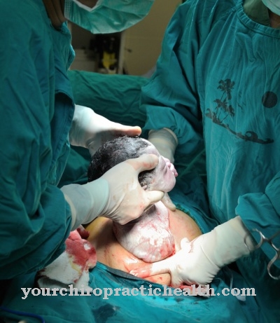 Caesarean section