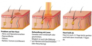 Tratamento a laser (terapia a laser)