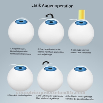 LASIK