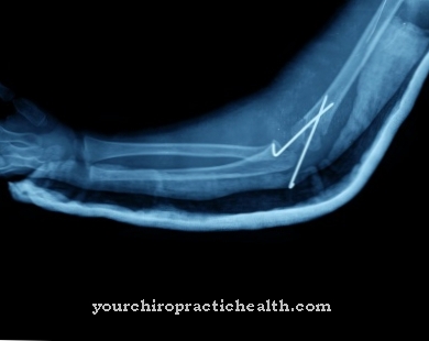 Osteosintesi del chiodo intramidollare