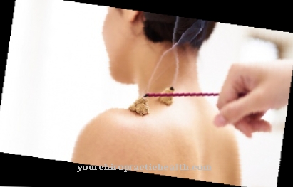 moxibustion