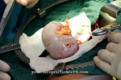 Kidney transplant