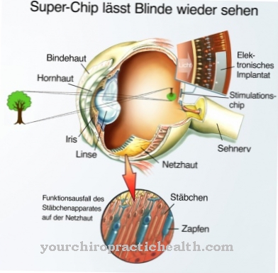 Retinalimplantat