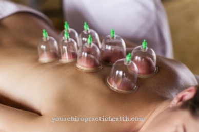 cupping