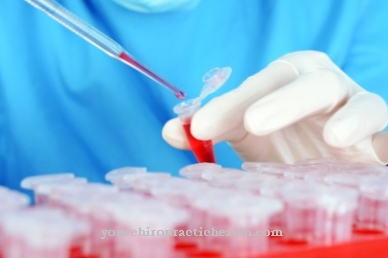 Stem cell transplant