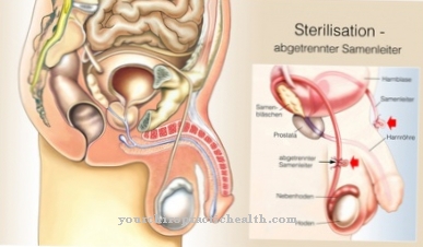 Sterilisasi (kontrasepsi)