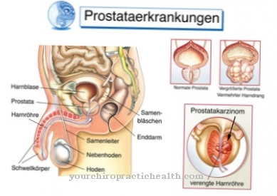 Transzuretrális prosztata reszekció