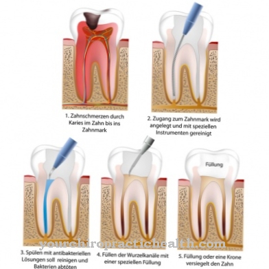 Root canal treatment