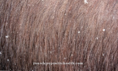 Home remedies for dandruff