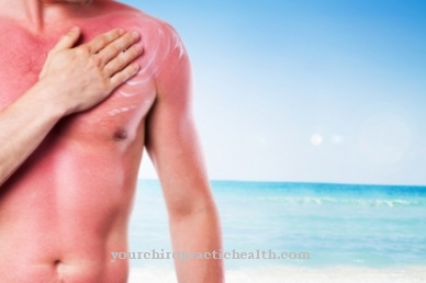 Home remedies for sunburn