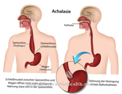 achalázia