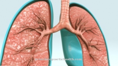 Acute Respiratory Distress Syndrome