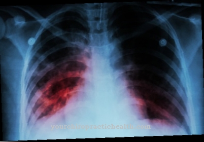 Acute respiratory failure