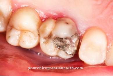 Amalgam poisoning