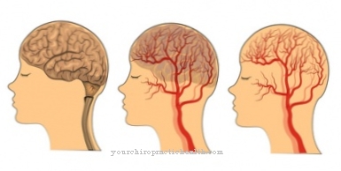 Amyloid angiopathy