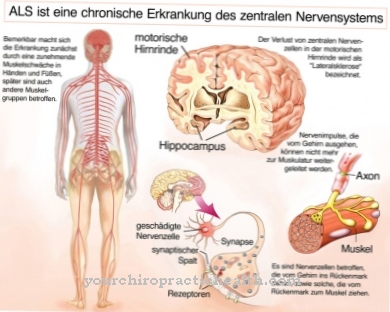 Amyotrophic Lateral Sclerosis