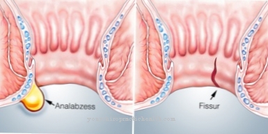 Fisura anus (robekan anal)