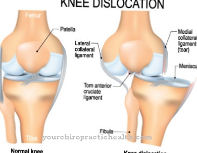 Aangeboren dislocatie van de knie