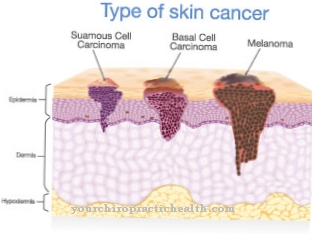 Angiosarcoma