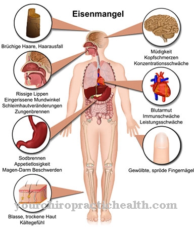 Niedokrwistość (anemia), niedokrwistość z niedoboru żelaza