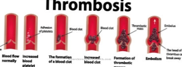 Sindromul antifosfolipidic