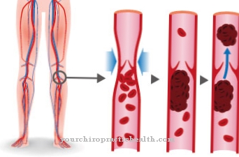 Antithrombin deficiency