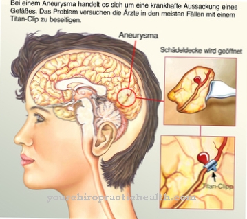 Aortic aneurysm