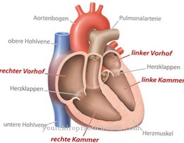 Aortic arch syndrome