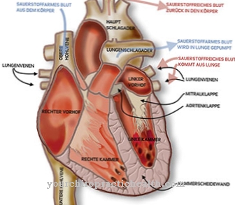 Aortic regurgitation