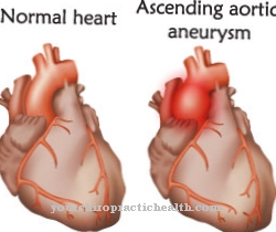 Aortas stenoze