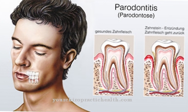 Apikaalinen periodontaalitauti