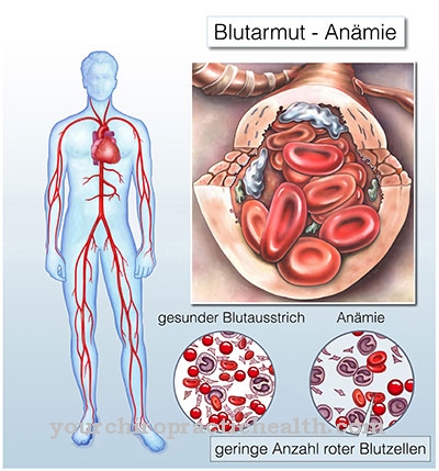 Anemie aplastica