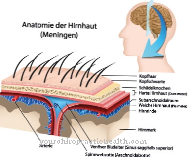 Arachnoid cyst