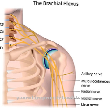 Arm plexus palsy