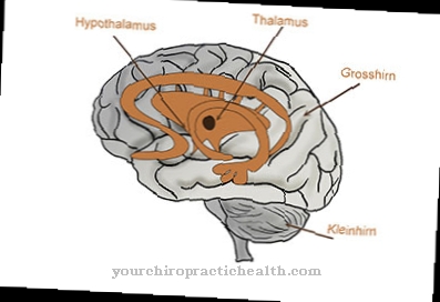 Arnold Chiari malformation